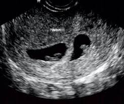 Radiographic features ultrasound first trimester. 11 Twins Ultrasound Ideas In 2021 Twins Ultrasound Ultrasound Twins