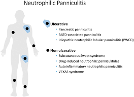 Image result for Panniculitis