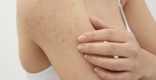 Image result for scabies on humans