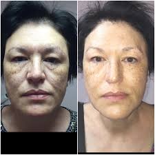 Sponsored blog: How I grew my client base by introducing one new treatment