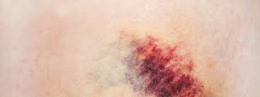 The term purpura refers to the appearance of reddish or purple spots on the skin. Idiopathic Thrombocytopenic Purpura 6 Signs Of This Rare Disorder Self