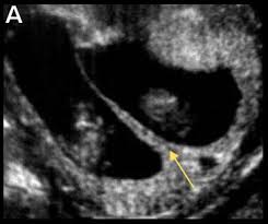 Maybe you would like to learn more about one of these? Twin Pregnancy New Zealand Obstetric Ultrasound Guidelines Ministry Of Health Nz
