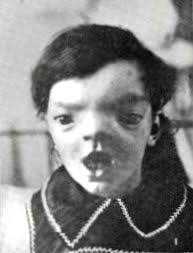 فرط التباعد