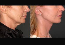 Andrew Jacono, MD, FACS