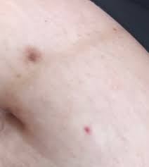 Red spots on skin can also appear as a part of some. Small Blood Spots On Skin September 2018 Babies Forums What To Expect