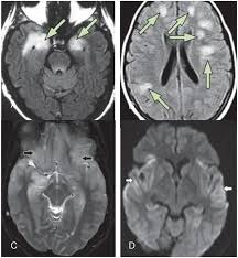 Two subtypes are recognised which differ in demographics, virus, and pattern of involvement. Frontiers Systematic Review Syndromes Early Diagnosis And Treatment In Autoimmune Encephalitis Neurology