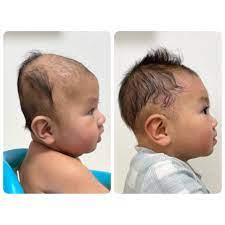 Before and after cranial remolding #plagiocephaly #plagiocephalyawareness  #craniosynostosis #torticollis #brachycephaly #pediatricorthotics  #pediatrics #babyhelmet #childrensop #lasvegaspediatrics  #childrensorthotics #cranialband #cranialhelmet ...