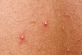 Depending on their causes, these pimples may have heads that will appear as boils, zits, whiteheads. Pictures Different Types Of Acne How To Treat Them