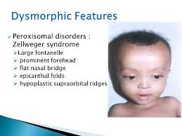The facial features superficially resemble those often seen in down syndrome patients with slanting (up or down) lid fissures and epicanthal folds. Recognize Iem In A Neonate With Non Specific Signs And Symptoms Make Use Of Simple Lab Tests In The Diagnosis Of Iem Initial Management Of Life Ppt Download