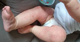 Image result for vyrážka u dětí