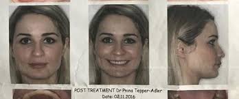 23 and I Want a Nice Smile!