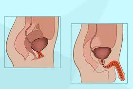 Urethritis in Females and Males: Healing Urethra Pain