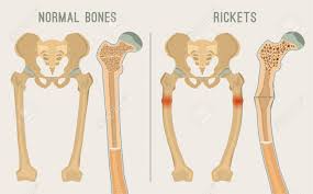 Related posts of cross section of human bone diagram bone anatomy of foot. Normal Bones Versus Rickets And Osteomalacia Medical Anatomy Royalty Free Cliparts Vectors And Stock Illustration Image 97623662