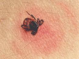 Typhus-Causes-Symptoms-Diagnosis-Treatment | Homeopathic | Best Homeopathic Doctor in Pakistan | Dr Qaisar Ahmed MD, DHMS