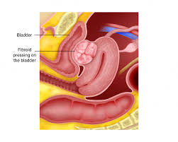 Dibawah ini tanda tanda ovulasi wanita sehat yang perlu diketahui. Bab 2 Fibroid Rahim Melaka Fertility Selva S Fertility Obstetrics And Gynaecology Clinic