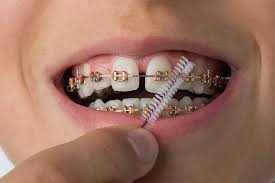Until you get rid of yellow strains, stick to water only, if you'll drink lot of colored beverages like coffee, tea etc. How To Look After Your Teeth After Getting Braces Looking After Your Braces
