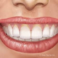 4 Important Facts About Gum Recession And What You Can Do About It Christopher Couri Dds Ms