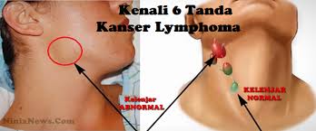 Bagi mereka yang masih belum mengetahui apa itu kanser kelenjar atau kanser limfoma, baca penjelasan dari pegawai perubatan ini dengan teliti agar tidak tersalah faham jika kelenjar pada badan. Kenali Jenis Ketulan Di Bahagian Leher Ketiak Dan Pangkal Peha Petanda Kanser Lymphoma Cara Hidup Sihat