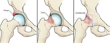 Please send your request to our: Femoroacetabular Impingement Orthoinfo Aaos