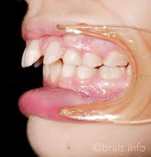 Dientes Superiores Desplazados Hacia Delante A Que Esperais
