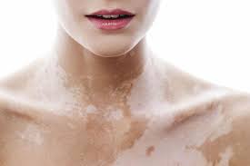 Vitiligo Symptome Ursachen Und Therapie Brigitte De