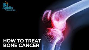 The macmillan cancer support website has more information about secondary bone cancer. Identifying And Managing Cancer Of The Bone Early Signs Of Bone Cancer Apollo Hospitals Youtube