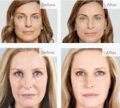 Before and after treatment photos from advanced dermatology & skin cancer center in northwest arkansas. Sculptra Aesthetic Revive Medical Spa Llc Fayetteville Arkansas