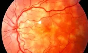 Image result for Uveitis