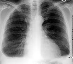 Ultrasound guided assessment of pleural effusion to determine and describe the size and site of the effusion. Chest Radiology