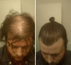 However, people of any age or sex may notice more hair collecting in their hairbrush or in the shower drain. Psa Sometimes Man Buns Are For Covering Bald Spots Album On Imgur