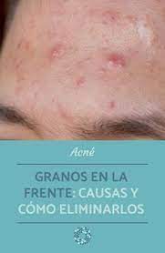 En Este Articulo De Onsalus Conoceras Mas Acerca De Los Granos En La Frente Causas Y Como Elimina En 2020 Como Quitar Granos Granos En La Frente Remedios Para Granos