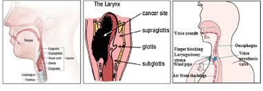 Fortunately, most laryngeal cancers are diagnosed at an early stage, which means the outlook is generally better than some other types of. A Anatomy Of Larynx B Larynx Cancer C Voice Prosthesis Download Scientific Diagram