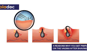 As i have mentioned before, irritation from shaving can cause ingrown hairs, which may become infected and result in razor bumps, which are small red bumps on. 4 Reasons Why You Get Pimples On The Vagina After Shaving Beauty And Skin Care Women S Health Oladoc Com