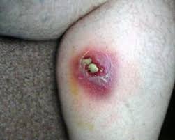 Image result for wolf spider bite skin