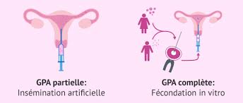 On peut sur catalogue, condition d'y mettre le prix, choisir la donneuse d'ovocytes ou le donneur de sperme selon certain de ces caractres (taille, poids, couleur. Quels Sont Les Differents Types De Gestation Pour Autrui