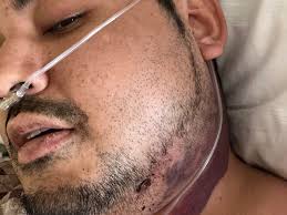 Fundraiser by Enrique Huesca Morales : Paying for medical bills for my  accident