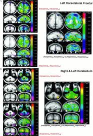 Android 11 based pixel experience 11 has been released for many phones. Comparison Of The Effects Of Risperidone And Haloperidol On Regional Cerebral Blood Flow In Schizophrenia Biological Psychiatry