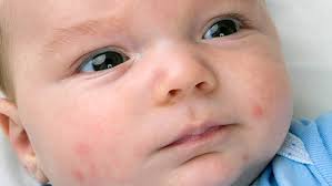 Maybe you would like to learn more about one of these? Eczema La Bebelusi Sfaturi Si Tratamente Bebee Ro