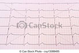 Heart Rhythm Chart