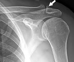Image result for Shoulder XRay