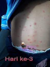 Chickenpox is a highly contagious infection that causes an itchy, spotty rash. Cacar Air Chicken Pox Di Kalangan Dewasa Janji Kita
