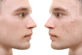 Check spelling or type a new query. How Effective Is Tretinoin Cream For Acne Save Health
