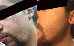 Laser hair removal is most effective when hair is in the growth stage. How 50 People From Reddit And Youtube Cleared Their Fungal Acne