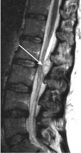 Image result for Spinal Epidural Abscess
