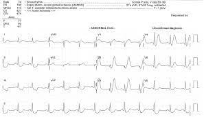 Jan 01, 2021 · ncbi bookshelf. De Winter T Wave Litfl Ecg Library Diagnosis