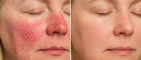 Image result for demodex rosacea