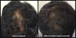 Intensive anti hair loos serum 100 ml (2). How Effective Is Xtra Denser Serum For Hair Loss Regrowth Of Hair Does It Have Any Severe Side Effects Is It Better Than Any Minoxidil Containing Product Quora