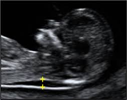 Down Syndrome Genetic Counseling