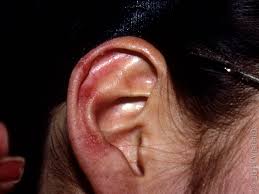 Image result for Chilblains