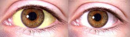 Soborno Aterrizaje Hospital Por Que Duelen Las Cuencas De Los Ojos Embodiedentrepreneur Co Uk